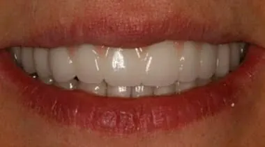 Case 1 after treatment at Roseville Topsmiles.