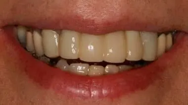 Case 1 before treatment at Roseville Topsmiles.