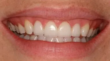 Case 2 after treatment at Roseville Topsmiles.