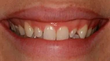 Case 2 before treatment at Roseville Topsmiles.