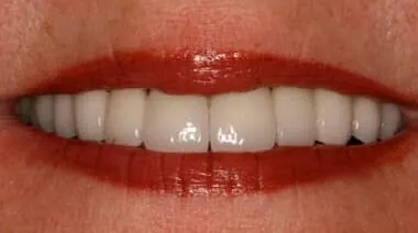Case 3 after treatment at Roseville Topsmiles.