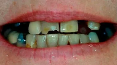 Case 3 before treatment at Roseville Topsmiles.