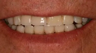 Case 4 after treatment at Roseville Topsmiles.
