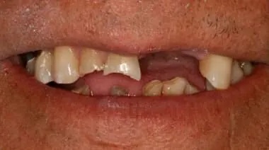 Case 4 before treatment at Roseville Topsmiles.