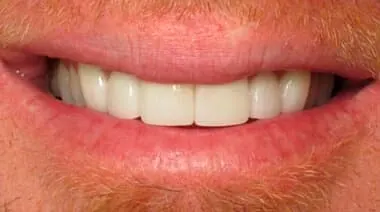 Case 5 after treatment at Roseville Topsmiles.