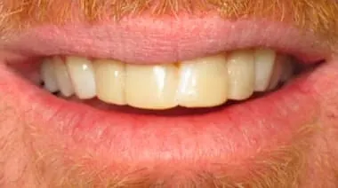 Case 5 before treatment at Roseville Topsmiles.