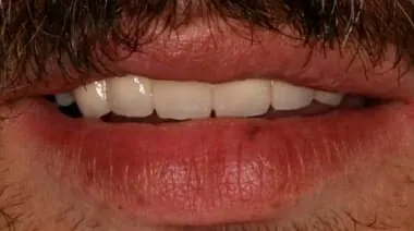 Case 6 after treatment at Roseville Topsmiles.