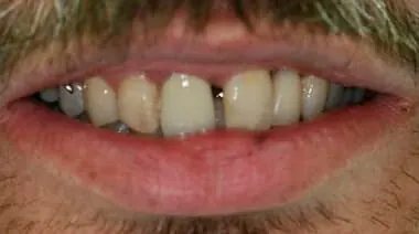 Case 6 before treatment at Roseville Topsmiles.