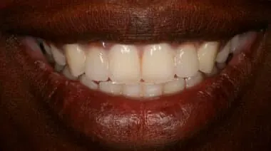 Case 7 after treatment at Roseville Topsmiles.