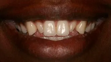 Case 7 before treatment at Roseville Topsmiles.