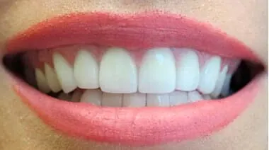 Case 8 after treatment at Roseville Topsmiles.