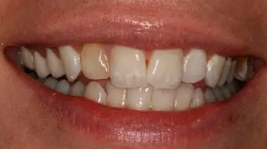 Case 8 before treatment at Roseville Topsmiles.